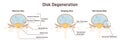 Disc degeneration stages set. flat Spine vertebrae anatomy scheme,