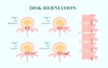 Disc herhetation, four stages and side view of spinal column