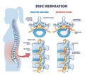 Disc herniation or spine nerve compression vs healthy anatomy outline diagram Royalty Free Stock Photo