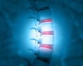 Disc problem of human spine Royalty Free Stock Photo