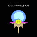 Disc protrusion. Top view. Spine. Infographics. Vector illustration on a black background