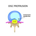 Disc protrusion. Top view. Spine. Infographics. Vector illustration on isolated background