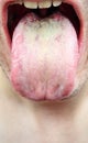 Disease infection tongue