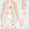 Disease of the joints and bones.