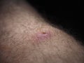 Disease people close up. pimple red inflamed purulent abscess on the skin of a man`s leg
