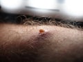 Disease people close up. pimple red inflamed purulent abscess on the skin of a man`s leg