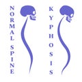 Disease of a spine. Kyphosis. Body posture defect. Blue skull with a silhouette of the spine. Vector illustration.