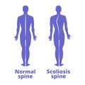 Disease of a spine. Scoliosis. Body posture defect. Blue human silhouettes . Vector illustration.