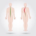 Disease of a spine. Scoliosis. Body posture defect. Human silhouettes isolated. Vector illustration.