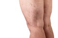 The disease varicose veins on a womans legs. white background Royalty Free Stock Photo