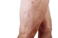 The disease varicose veins on a womans legs Royalty Free Stock Photo