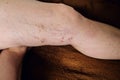 The disease varicose veins on a womans legs Royalty Free Stock Photo