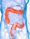 A diseased colon Royalty Free Stock Photo