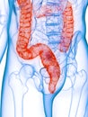 A diseased colon Royalty Free Stock Photo