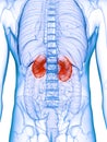 A diseased kidney