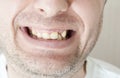Diseased teeth of the patient