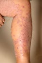 Diseases caused by abnormalities of the lymph. Psoriasis is a skin disease Royalty Free Stock Photo
