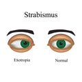 Diseases of the eye - strabismus. A variation of strabismus - Esotropia Royalty Free Stock Photo