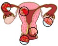 Diseases of female reproductive system Royalty Free Stock Photo