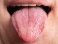 diseases of the oral cavity, tongue infections cancer Royalty Free Stock Photo