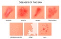 Diseases of the skin