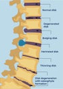 Diseases of the spine. Degenerative changes in the vertebrae Royalty Free Stock Photo