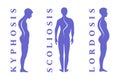 Diseases of the spine. Scoliosis, lordosis, kyphosis. Body posture defect. Human silhouettes on white. Vector illustratio