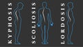 Diseases of the spine. Scoliosis, lordosis, kyphosis. Body posture defects. Back curvature. Spinal deformity types