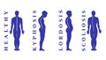 Diseases of the spine. Scoliosis, lordosis, kyphosis. Body posture defects. Back curvature. Spinal deformity types