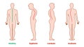 Diseases of the spine. Scoliosis, lordosis, kyphosis. Body posture defects. Back curvature. Spinal deformity types