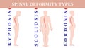 Diseases of the spine. Scoliosis, lordosis, kyphosis. Body posture defects. Back curvature. Spinal deformity types