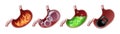 Diseases of stomach. Medical vector illustration set.