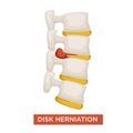 Disk herniation spine disease bone inflammation vector illustration