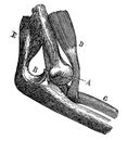 Dislocation of the elbow joint.