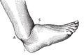 Dislocation of the foot forward, vintage engraving