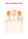 Dislocation of hip