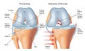 Dislocation of knee