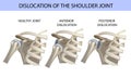 Dislocation of the shoulder joint, medical vector illustration Royalty Free Stock Photo