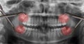 Display four wisdom teeth over x-ray Royalty Free Stock Photo