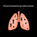 Disseminated tuberculosis. Vector illustration on a black background Royalty Free Stock Photo