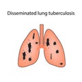 Disseminated tuberculosis. Vector illustration on isolated background Royalty Free Stock Photo