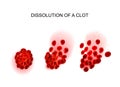 Dissolution of the clot. thrombolysis Royalty Free Stock Photo