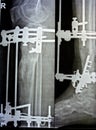 Distal comminuted fracture fibula managed by plate and screws, distal tibia managed by external ring fixator ILIZAROV frame with