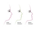 Distal, Normal, and Mesial bite profile, vector illustration. Overbite or underbite before and after orthodontic