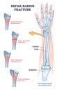 Distal radius fracture and broken arm bone types anatomy outline diagram