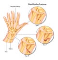 Distal radius fractures