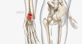 Distal radius fractures are among the most common types of fractures and are most common in the upper extremities