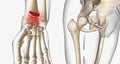 Distal radius fractures are among the most common types of fractures and are most common in the upper extremities