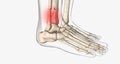 Distal tibia fractures affect the ankle joint and can often involve a fracture of the fibula