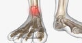 Distal tibia fractures affect the ankle joint and can often involve a fracture of the fibula